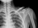 Bone Fractures May Soon Be Healed By Injectable “Microbots”